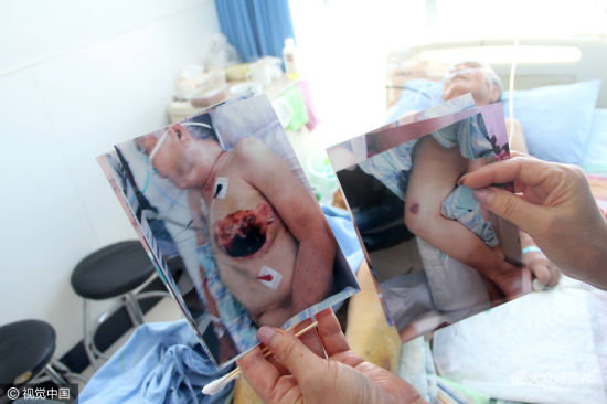 山东东营老母亲遭儿子儿媳虐待 乳房被烫平