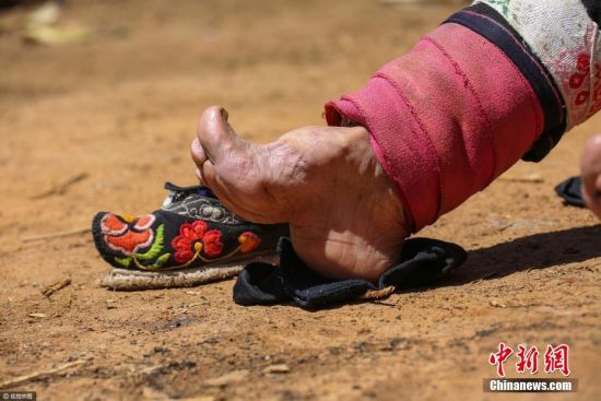 最后的“裹足老人” 三四岁就开始缠脚