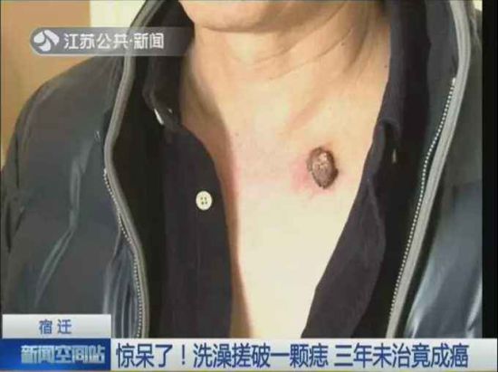 洗澡搓破痣竟成癌 其实是一种低度恶性肿瘤