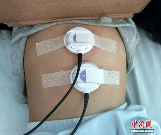 图为患儿在医院接受电子艾灸治疗。(资料图,医院供图) 图为患儿在医院接受电子艾灸治疗。(资料图,医院供图)